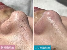 ティーツリー(Tea Tree)の雰囲気（深刻な黒ずみ＆黒ニキビはサロンケア＆ホームケアで改善します）