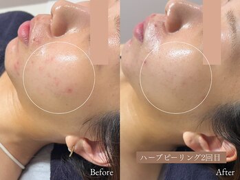 ラティエ(Latier)/お肌の土台を整えるハーブ