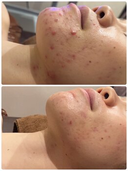 ツヤハダコガオ 千葉店/before⇒after 【プラズマ】