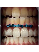 ホワイトニングショップ 武蔵小杉店/武蔵小杉ホワイトニング美白ケア