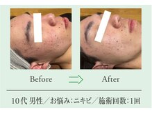 エステプロ ラボ 自由が丘/Before→After