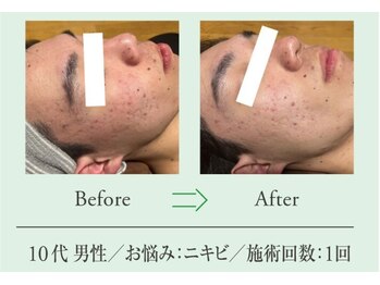 エステプロ ラボ 自由が丘/Before→After