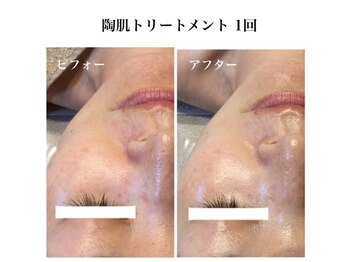 ライチャス(RAICHAS)/陶肌トリートメント１回の効果◎