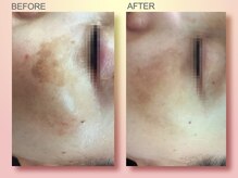 ジュリア オージェ 天王寺店/ ビフォーアフター（シミケア）