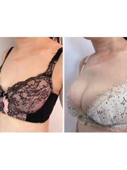 バストラインを整えたい