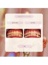 プラスビーセルフ(+b self)/ホワイトニングビフォーアフター