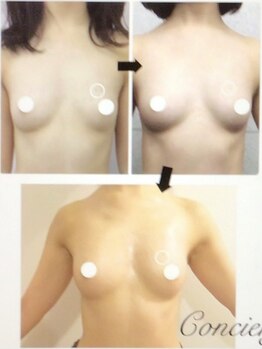 サロン アイミー(salon i me)/【バストアップ】症例