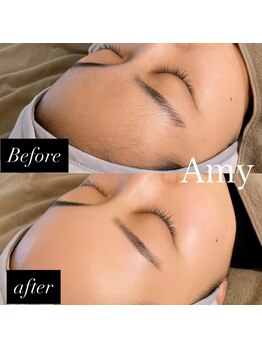 エイミー(Amy)/人気No.1［フェイス脱毛］