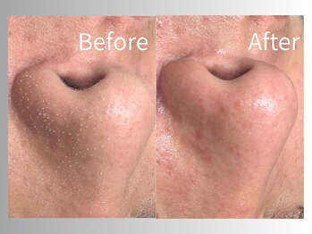 クレーヌ(CREINE)/毛穴洗浄