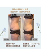 ルアナ(Luana)/脂肪分解＆燃焼！引き締めケア