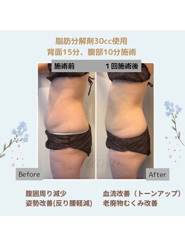 ルアナ(Luana)/脂肪分解＆燃焼！引き締めケア