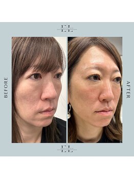 縁(エニシ)/最新美容　Exo  Lift