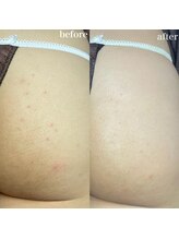 ちらちゅら/クリスティーナ【施術2回】経過