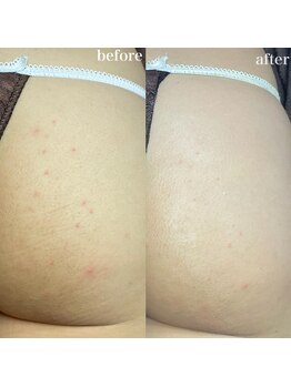 ちらちゅら/クリスティーナ【施術2回】経過