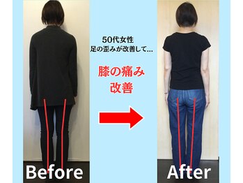 ソヴァール(SAUVEUR)/50代女性　足の歪みから膝痛