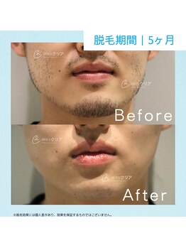 メンズクリア 西宮店/【メンズクリア】お客様の施術例