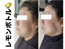 ブレア(Blair)/脂肪分解液＋むくみ取り