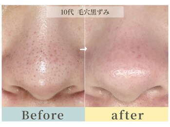 ムク(Muqu.)/毛穴EXで黒ずみ詰まりさよなら