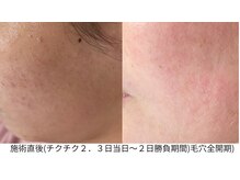 ラビエス(LAVIES)/【当日耕し】回復サイクルの目安