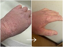 エミナル(eminal)/ビフォー/アフター/毛穴/梅田