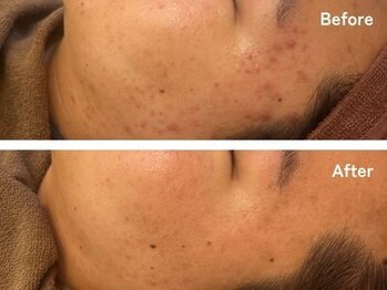 ギルドハナレ(GUILD HANARE)/"W施術"