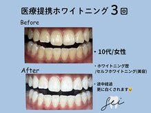 セイ(sei)/ホワイトニング途中経過