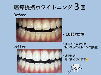 セイ(sei)/ホワイトニング途中経過