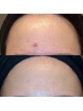 エラ(ella)/２０代ニキビケア