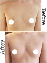 カリーナ(Carina)/バストアップBefore→after