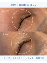 オン(on.)/施術一回での変化です♪