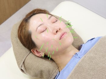 世珍鍼灸院 門前仲町店の写真/骨格・筋肉・内側から引き上げる本格美容鍼。エステとは違う、キュッと引き締まった理想の小顔へ。