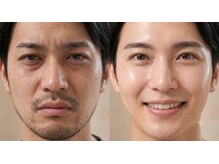 エクラ(eclat)/メンズ毛穴ケア