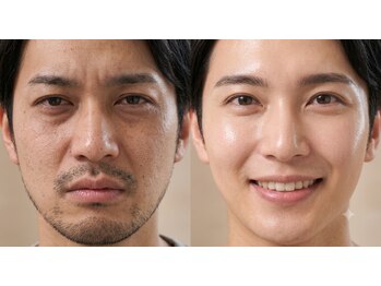 エクラ(eclat)/メンズ毛穴ケア
