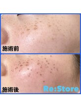 リーストア(Re:Store)/シミケア