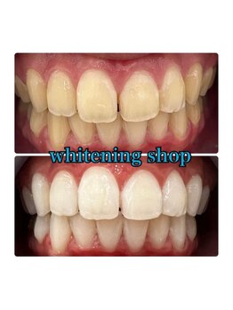 ホワイトニングショップ 所沢店/ホワイトニングショップ所沢店