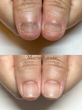 マリーロール 淀屋橋本店(Marie Laure)/自爪育成/深爪矯正/ネイルケア