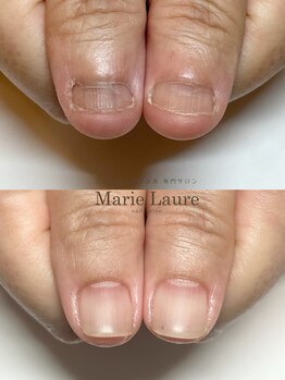 マリーロール 淀屋橋本店(Marie Laure)/自爪育成/深爪矯正/ネイルケア