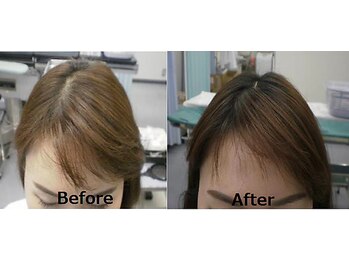 ブーチ 本八幡( BUHTI)/スカルプ/ヘッドスパヒト幹導入