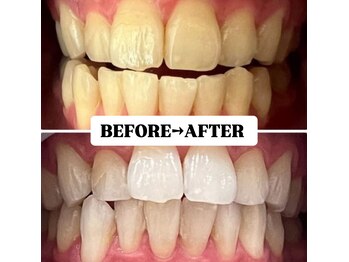 ホワイトニングサロン 豊中/Before&After美白ホワイトニング