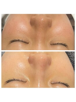 レミリー(Lemiry)/毛穴ケア