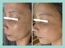 ミウル 天王寺店(miulu)/シミ照射