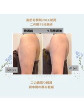 ルアナ(Luana)/脂肪分解＆燃焼！引き締めケア