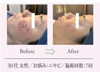 エステプロ ラボ 自由が丘/Before→After