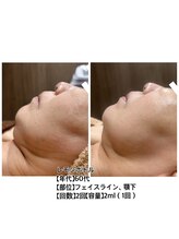 キャロリーヌ新宿店/60代レモンボトル効果