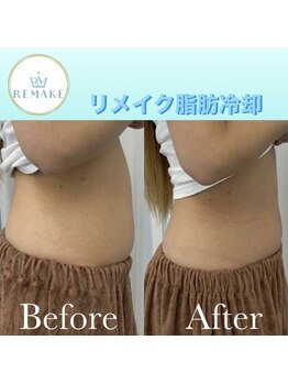リメイク 銀座(REMAKE)/脂肪冷却