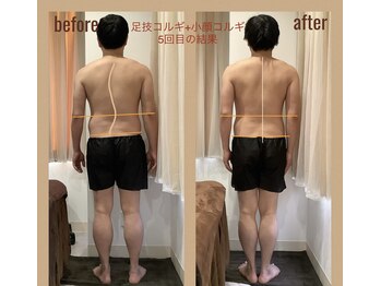 レアフィート(Rheafeet)/5回目の症例写真