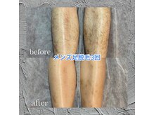 シュバル(CHEVAL)/人気足脱毛！効果実感♪