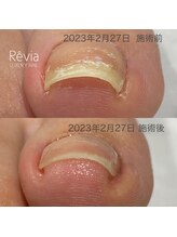 レヴィア(Revia)/巻き爪ケア