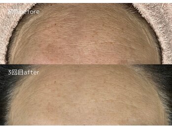 エムズ(emus.)/しわ改善の効果も◎プラズマ！