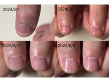 エルシャイン(L-shine)/深爪矯正